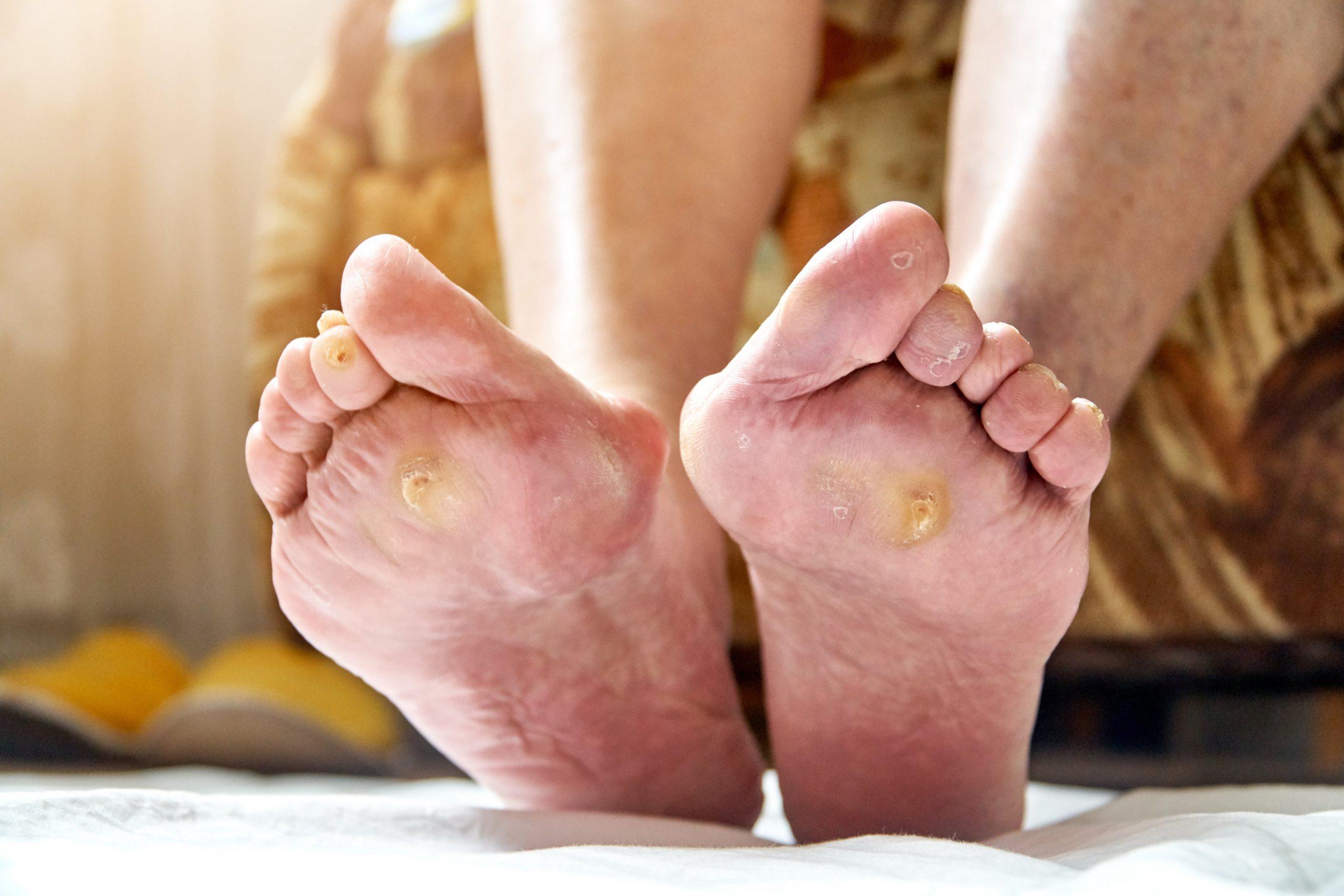 Best Diabetic Foot Ulcer Treatment Near Me: A Complete Guide 
