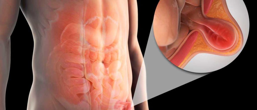 Choosing the Right Lap Hernia Specialist in Chandigarh for Safe Surgery 