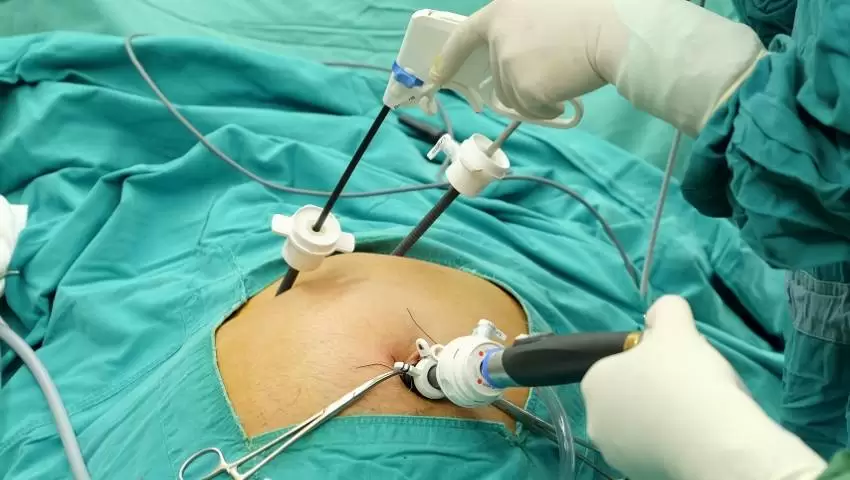 laparoscopic gallbladder removal Mohali