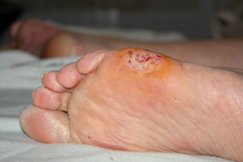 Why Choosing the Right Diabetic Foot Ulcer Treatment Near Me Matters for Your Health