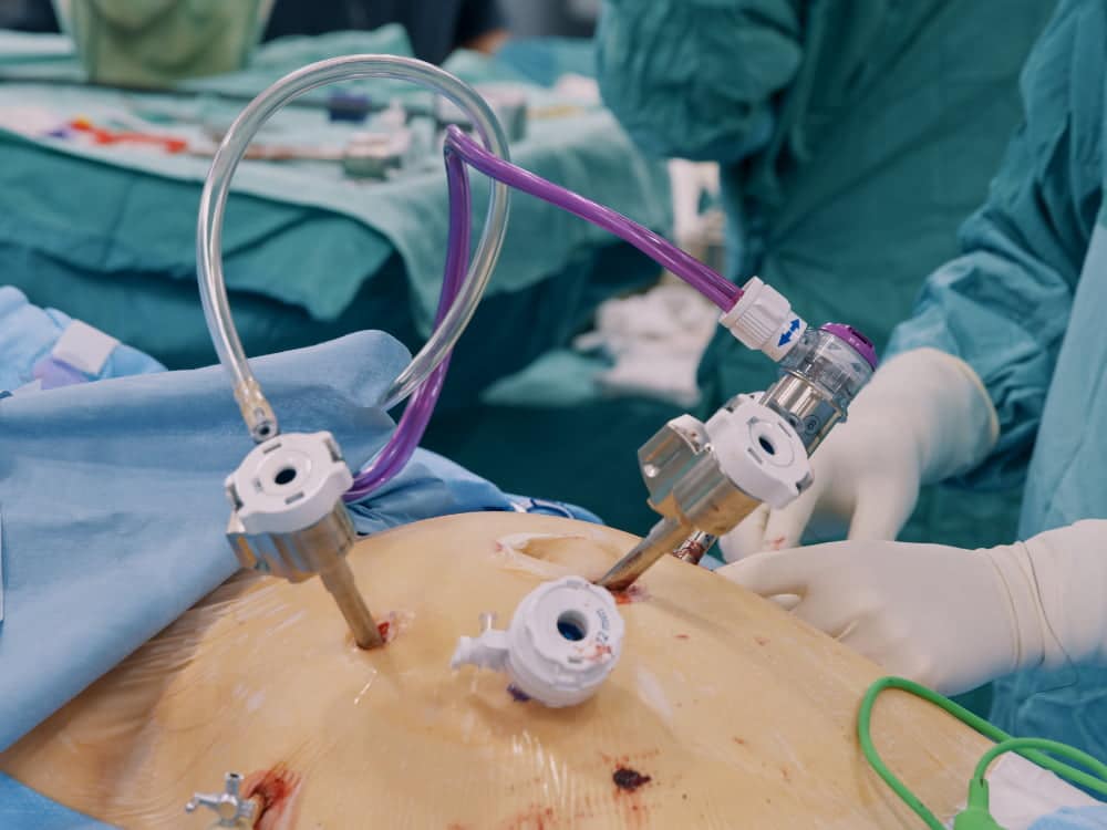Laparoscopic Gallbladder Removal in Mohali: Procedure, Recovery & Benefits