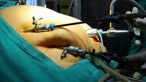 Laparoscopic Gallbladder Removal in Mohali