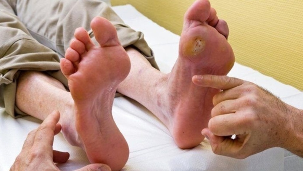Diabetic Foot Ulcer Treatment Near Me